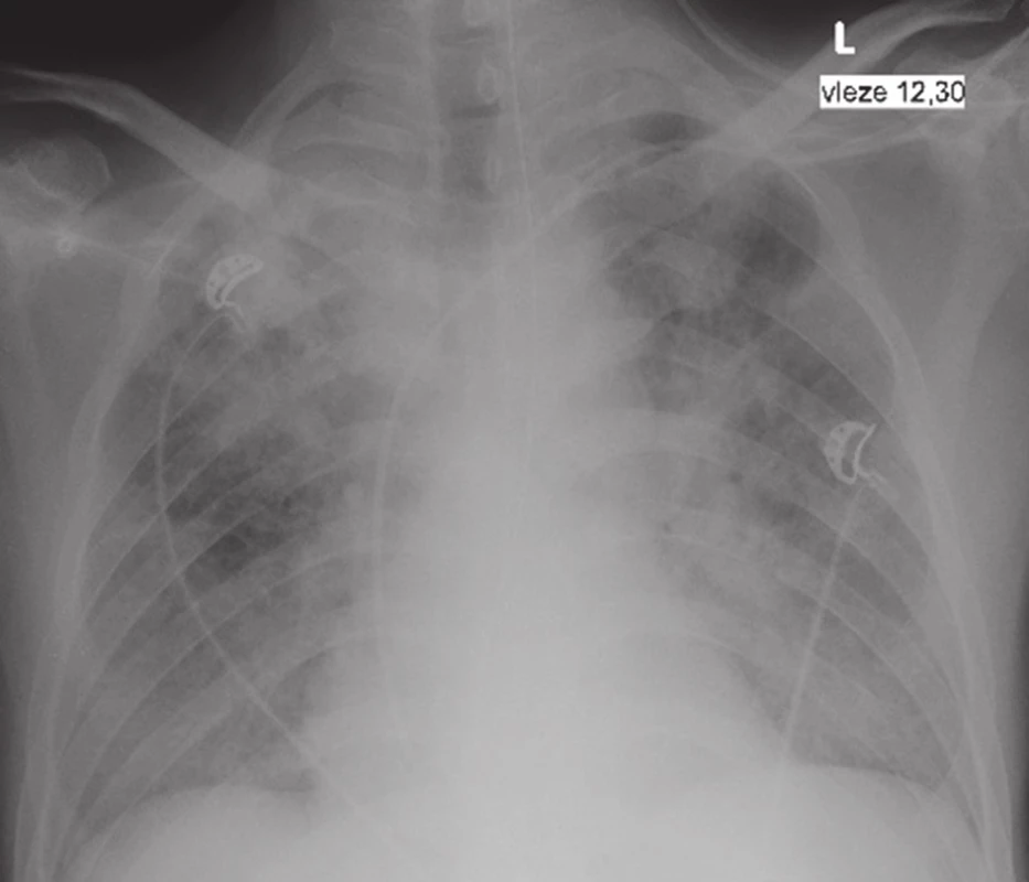  X – Ray finding: TB infiltrates in both pulmonary fields