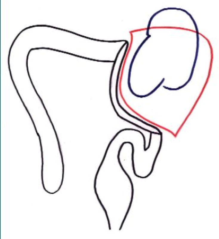 Laterokolický přístup k ledvině s odklopením flexury tlustého střeva.