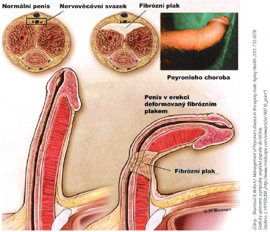 PD plak – řez penisem (3) 
Fig. 8 PD plaque – cut cross section of penis (3)