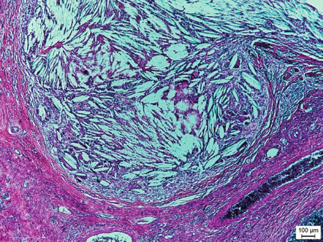 Mikrofotografia týmusovej cysty z akcesórneho tkaniva týmusu lokalizovaného na krku 7-ročného chlapca. Cystický útvar je lemovaný retikuloepitelovými bunkami týmusu a je vyplnený cholesterolovými kryštálikmi a viacjadrovými fagocytujúcimi bunkami (hematoxylín a eozín, mierka v obrázku = 100 μm).
Fig. 2. Microphotography of the thymus cyst from accessory thymus tissue localized on the neck of a 7-year-old boy. The cystic formation is lined by reticuloepithelial cells of thymus and filled with cholesterol crystals and multinuclear phagocyte cells (hematoxylin and eosin, line = 100 μm).