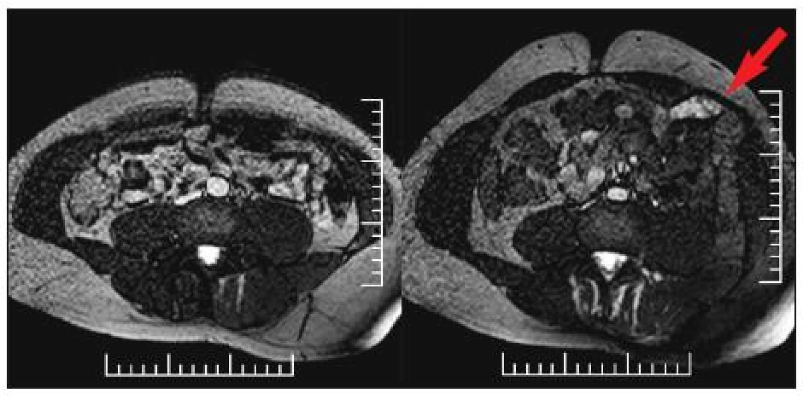  MRI břišní stěny (dynamické sekvence) u 38letého pacienta s pooperačním poškozením interkostálních nervů Th 10–11 vlevo. Na obrázku vlevo je nález v oblasti břišní stěny při klidném dýchání, kdy je nález na břišní stěně stranově symetrický, na obrázku vpravo je nález při Valsalvově manévru, kdy je patrné atrofické zeslabení a zřetelné vyklenování šikmých břišních svalů vlevo ve srovnání s pravou stranou.