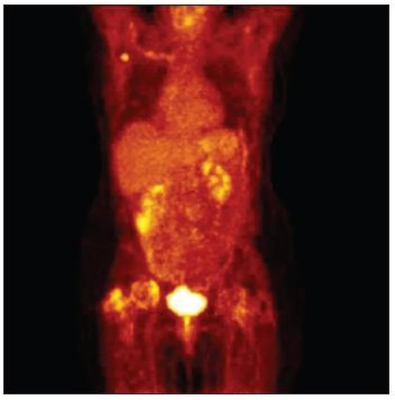 PET/CT – metabolicky aktivní uzlina v pravé axile
Fig. 12. PET/CT – metabolic active lymph node in the right axilla