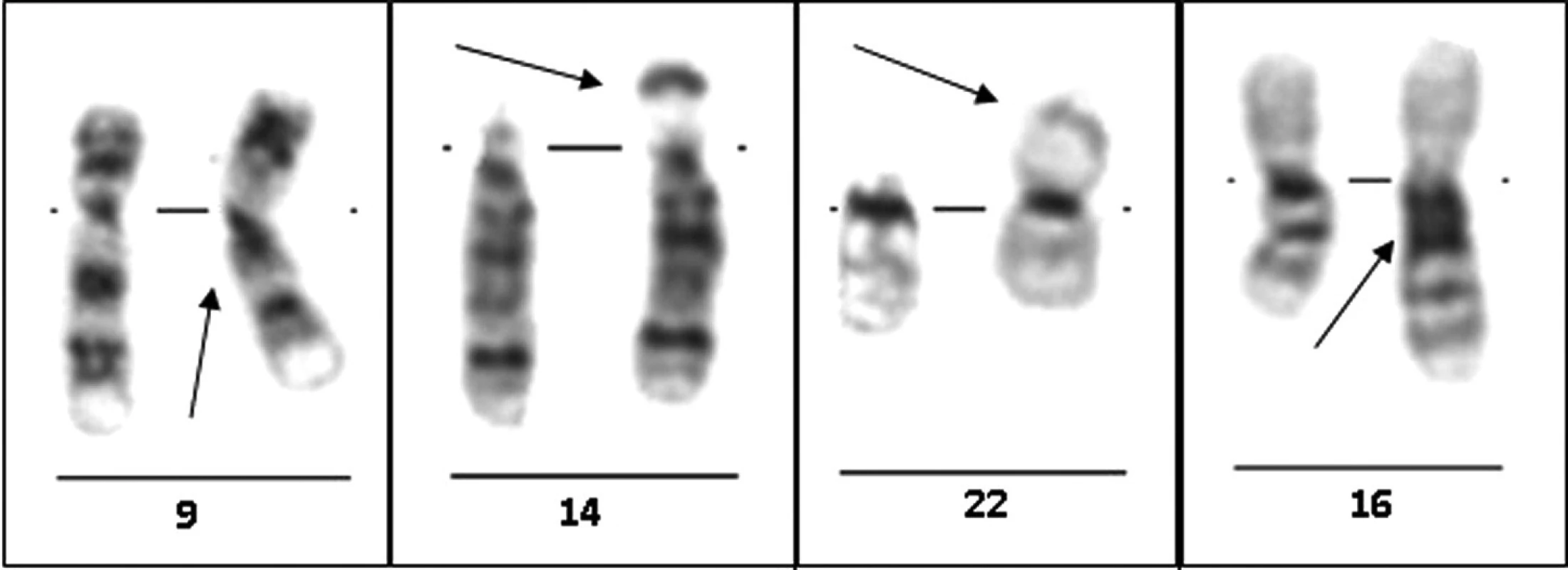 Vybrané varianty lidského karyotypu – standardní cytogenetické vyšetření: G-pruhování, zleva doprava: inv(9)(p12q13), 14ps+, 22pstk+ a 16qh+