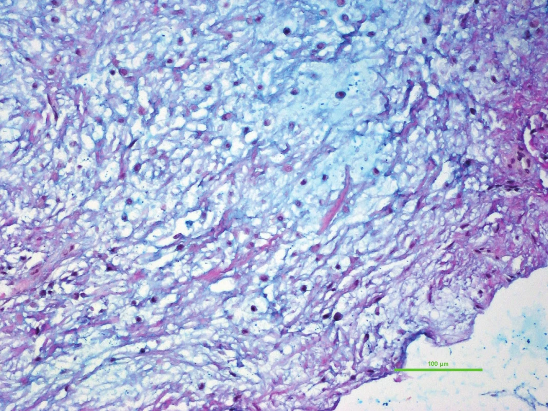 Společným znakem myxoidních nádorů měkkých tkání je hojné množství mezibuněčné hmoty, která se barví modře při speciálním barvení alciánovou modří. Intramuskulární myxom, původní zvětšení 200x.