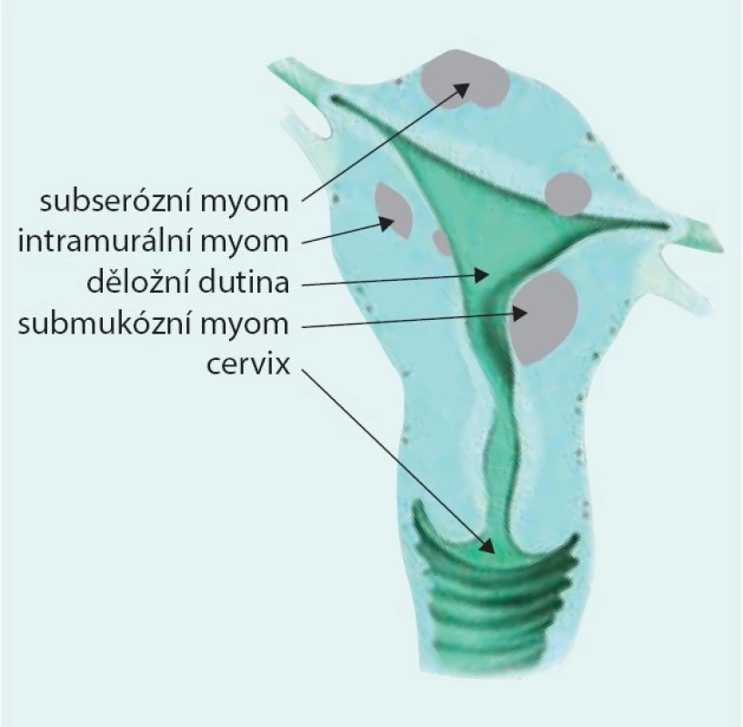 Klasifikace myomů podle lokalizace vzhledem k jednotlivým vrstvám děložní stěny