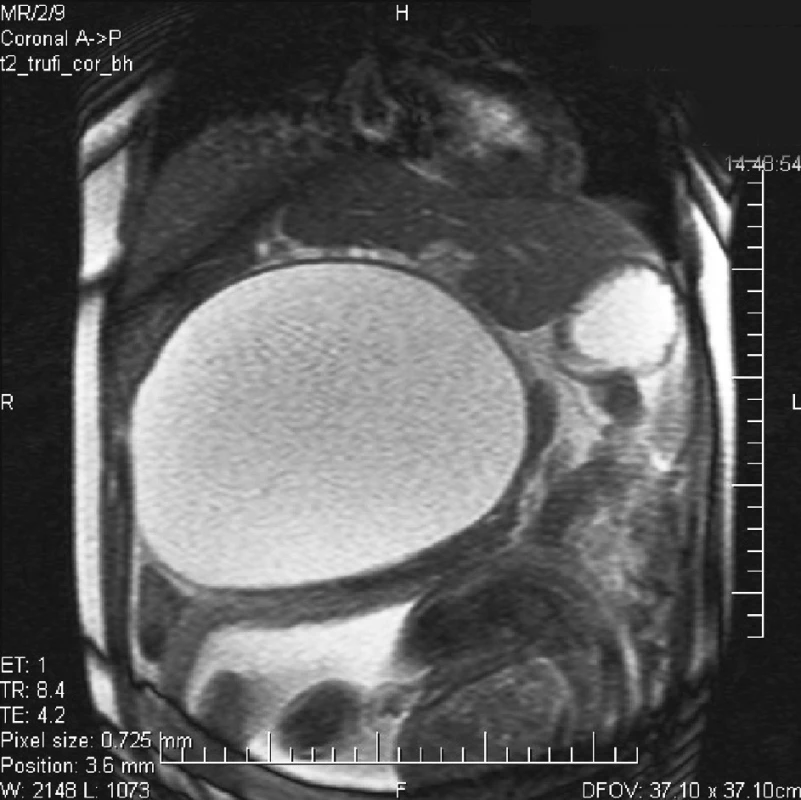 MR nález dutiny brušnej znázorňujúci cystu s kontrastom
Pic. 1. MR intraabdominal finding, depicting a cyst with a contrast