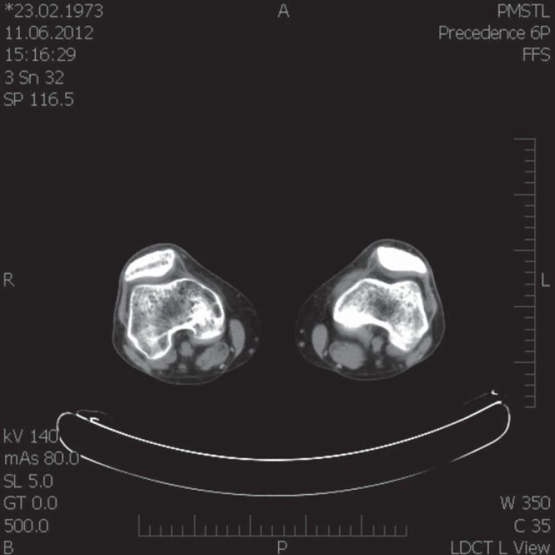 CT femuru a tibie (červen roku 2012). Nehomogenní (zřejmě ustupující) dekalcinace kondylů femoru.