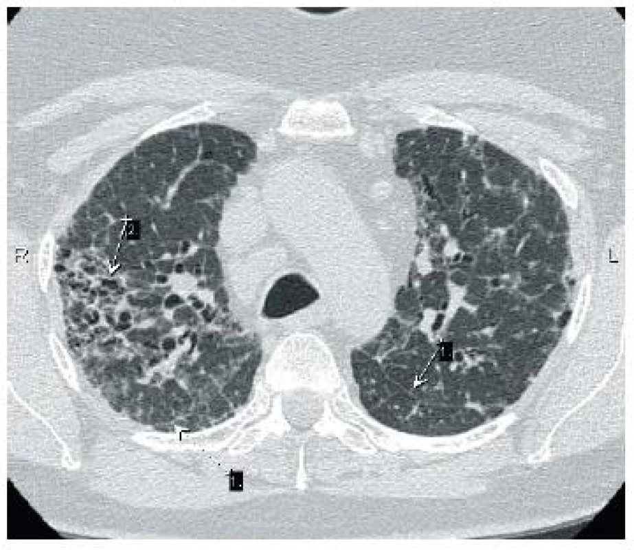 Histologicky ověřeno, nález nelze jednoznačně zařadit – sarkoidóza vs. chronická hypersenzitivní pneumonie