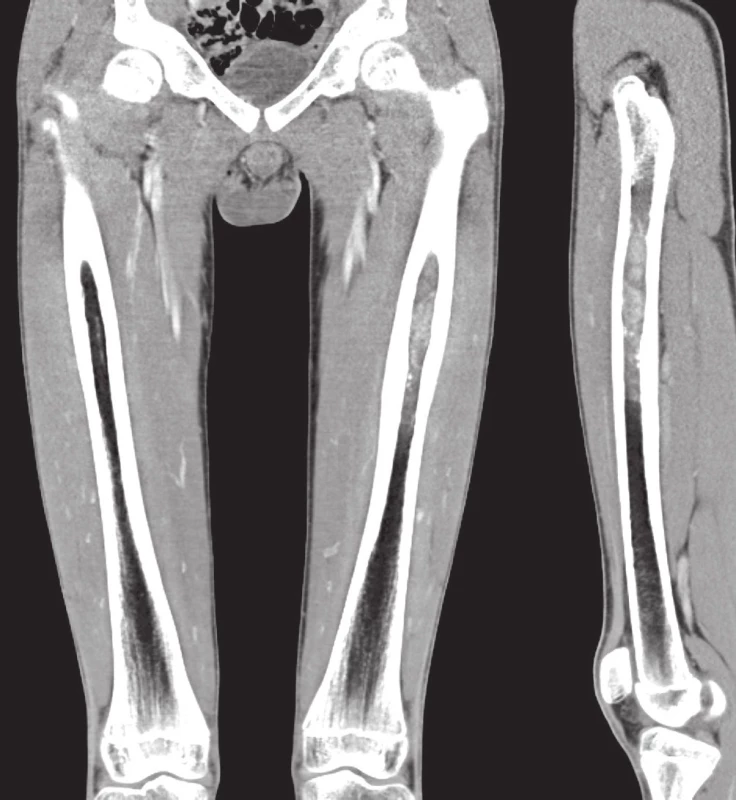 Případ 1. A. Primární osteolytická léze centrální diafýzy humeru bez známek šíření do okolí (CT). B. Rozsáhlá místní recidiva s kompletní destrukcí štěpu i přilehlé původní kosti a poškozením kovové osteosyntézy; masívní progrese tumoru do měkkých tkání (RTG). C. Případ 2. Primární osteolytická léze excentricky uložená v diafýze femuru bez porušení kompaktní kosti a známek šíření do okolí (CT s kontrastem).