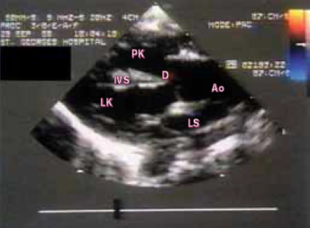 Parasternální pohled v dlouhé ose u dítěte s Fallotovou tetralogií ukazuje nasedající aortu nad interventrikulární septum, čímž se vytvořil septální komorový defekt.
