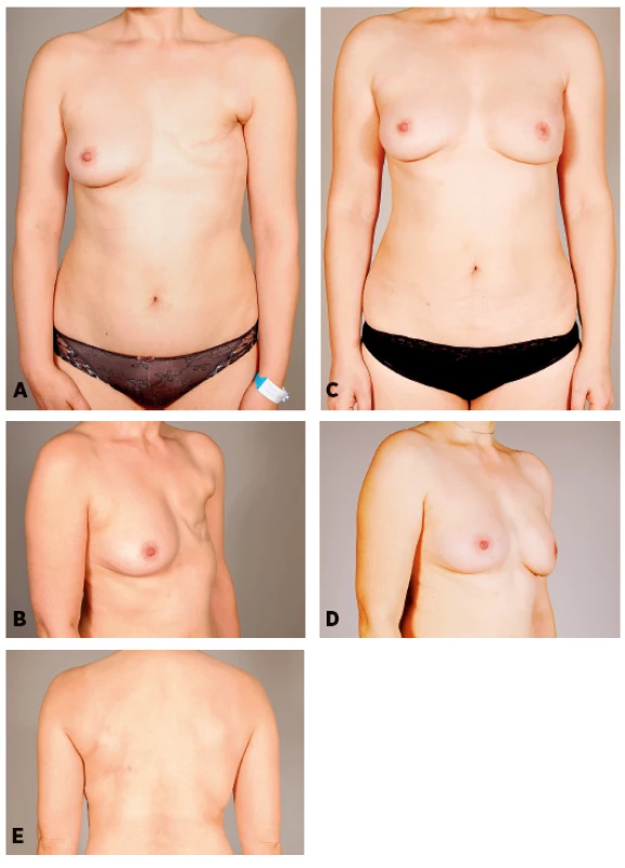 Patient 6: A 43-years-old women 48 months after mastectomy and adjuvant radiotherapy. She refused to have a scar on her abdomen. She underwent latissimus dorsi breast reconstruction associated with fat grafting into the pectoralis (40 ml) and latissimus dorsi (50ml) muscles, and with abdominal advancement flap. Two additional sessions of lipomodelling (205 and 130 ml) were performed to increase breast volume. One resulting horizontal scar on the breast and dorsal scar hidden in the bra. Preoperative and postoperative frontal, oblique and dorsal views, follow-up 22 months