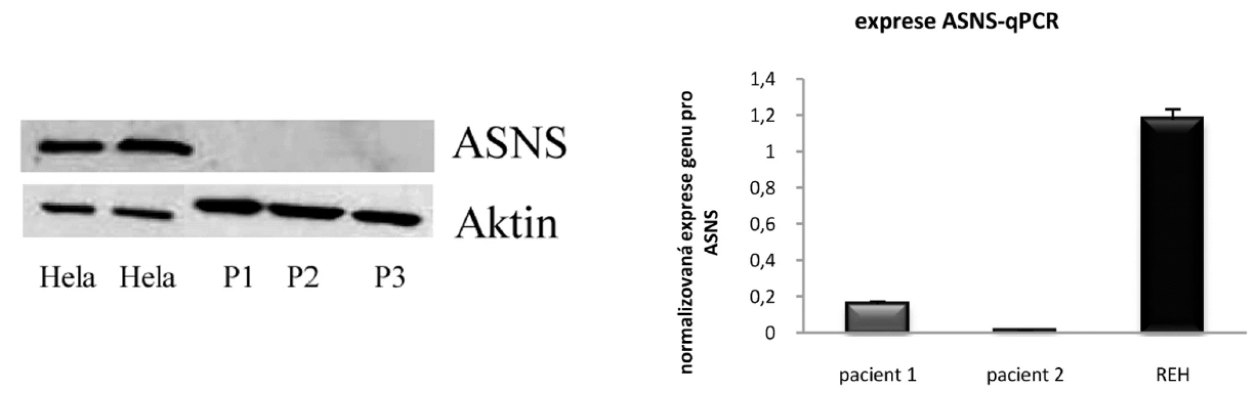 Protein ASNS detekovaný metodou Western Blot u buněčné linie Hela. U klinických vzorků nebyla detekce úspěšná, P1, P2 a P3 – označení pro pacientské vzorky. Bazální hladiny genu pro ASNS stanovené pomocí qRT-PCR u linie REH a dvou klinických vzorků.