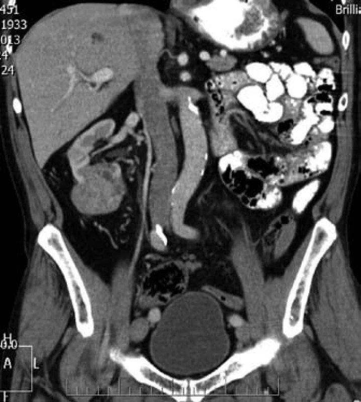 CT – tumor pravé ledviny.
Fig. 3. CT – tumor of the right kidney.