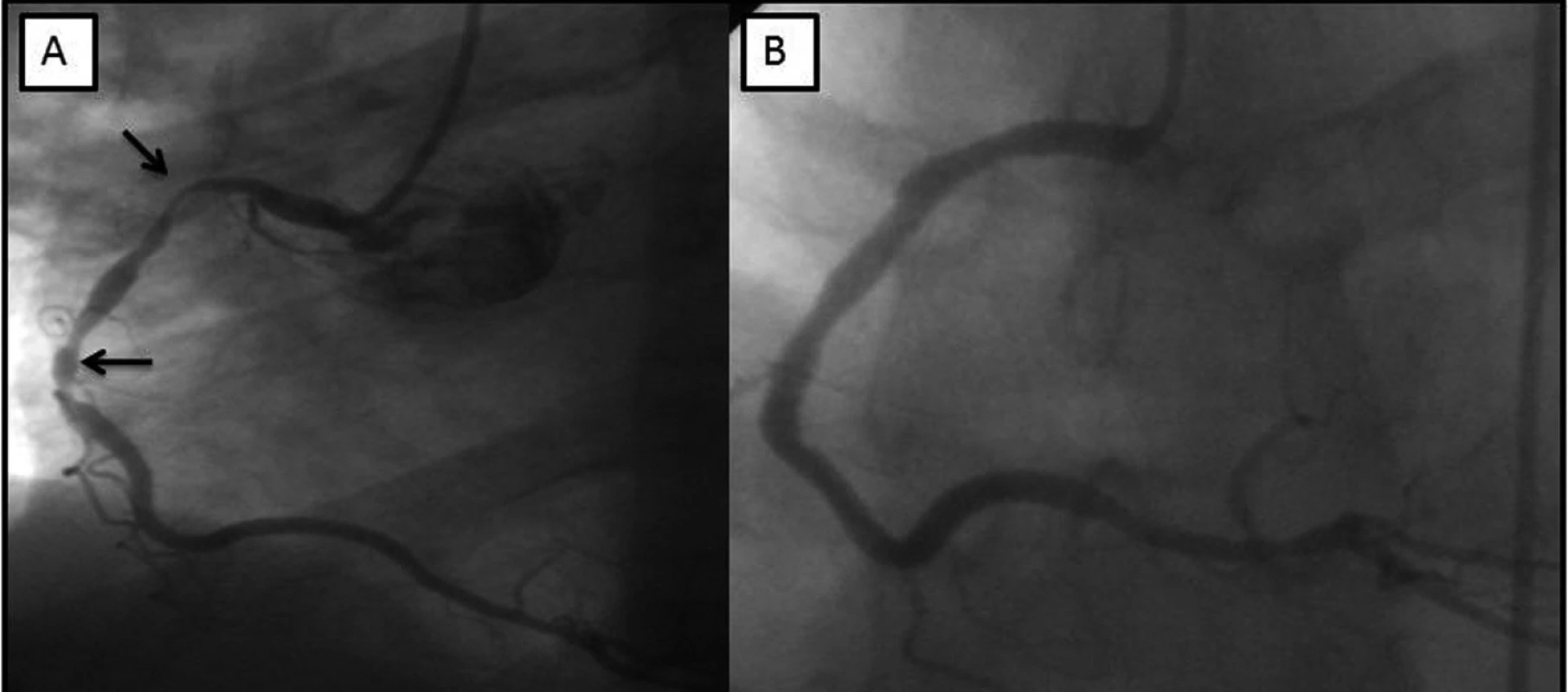 V levé části obrázku (A) je zobrazená pravá koronární tepna s významnými stenózami v její proximální a střední části (šipky). V pravé části obrázku (B) je patrný dobrý efekt po implantaci intrakoronárních stentů.
