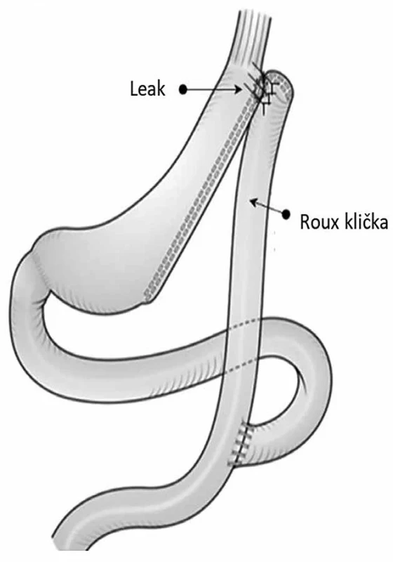 Korekce leaku pomocí Rouxovy kličky a vytvoření fistulojejunoanastomózy    Fig. 2: Correction of the leak using a Roux loop and fistulojejunostomy