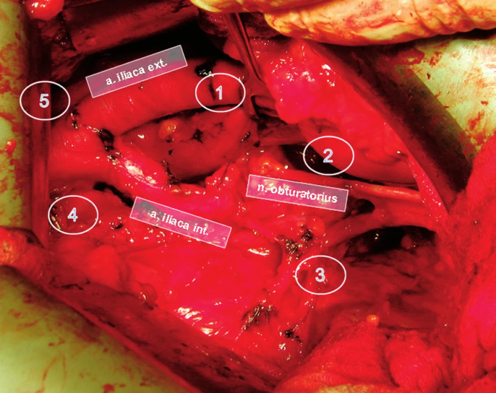 Levá pánevní strana po „rozšířené“ pánevní lymfadenektomii z extraperitoneálního přístupu s označenými regiony lymfatického spádu 1 – zevní ilická oblast, 2 – obturatorní oblast, 3 – vnitřní ilická oblast, 4 – presakrální oblast, 5 – společná ilická oblast
Fig. 2. Left pelvic side after completion of extended pelvic lymphadenectomy. Lymphatic drainage regions are indicated. 1 – external iliac, 2 – obturator, 3 – internal iliac, 4 – presacral, 5 – common iliac