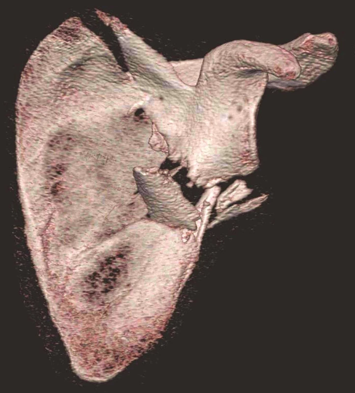 Třídimenzionální CT rekonstrukce – pohled z ventrální strany
Fig. 3: Three-dimensional CT reconstruction – anterior view