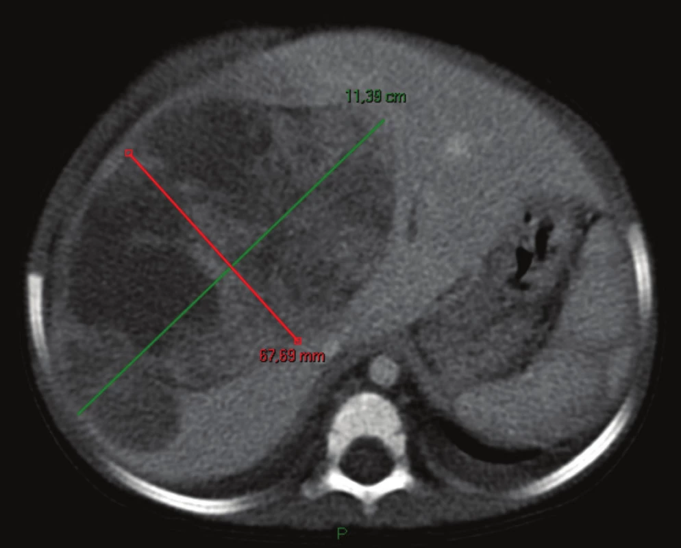 Hepatoblastóm pred neoadjuvantnou liečbou, pacient č. 2
Fig. 3: Hepatoblastoma before neoadjuvant therapy, patient No. 2