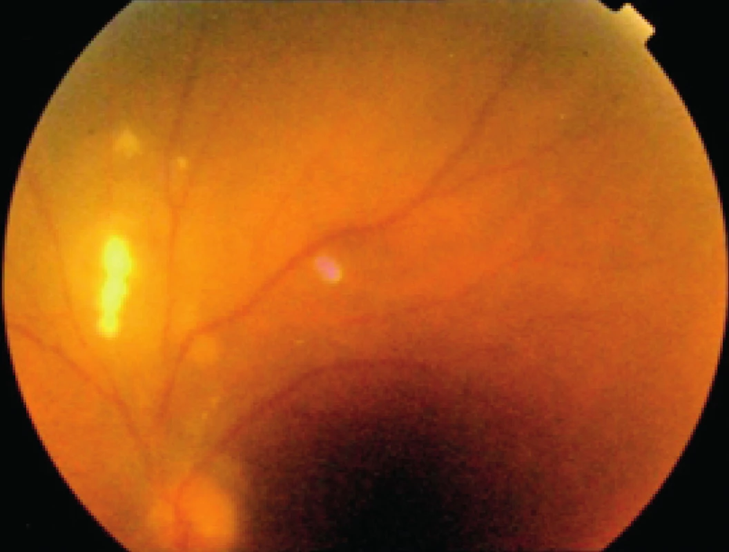 Oční forma larvální toxokarózy (podle MUDr. Lenky Pindurové – Nemocnice Frýdek-Místek)