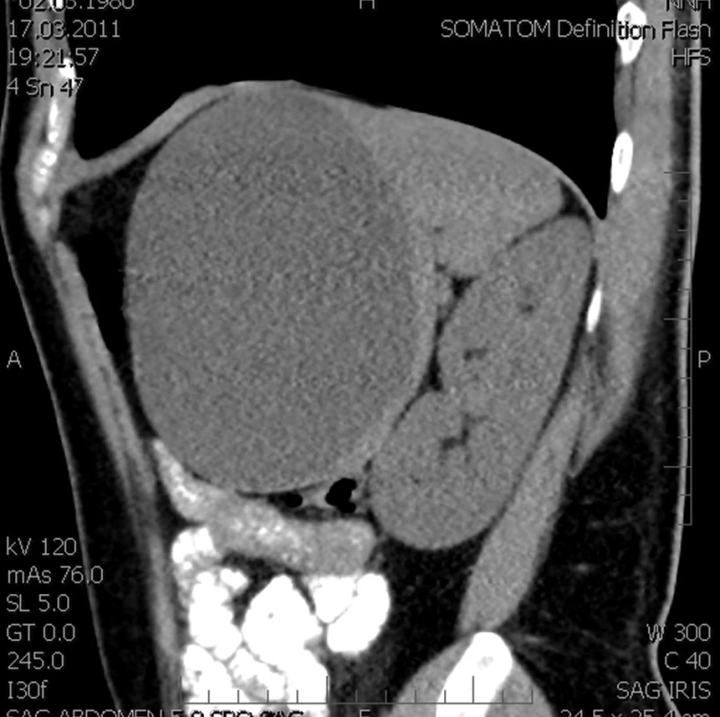 CT před punkcí - sagit. řez (kazuistika 2)
Fig. 6: CT veiw prior to punctioning- sagittal view (case 2)
