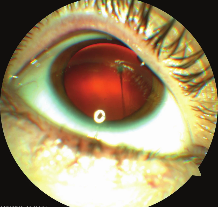 Barevný fotografický snímek předního segmentu pravého oka: perzistující arteria hyaloidea upínající se k zadní části pouzdra nitrooční čočky