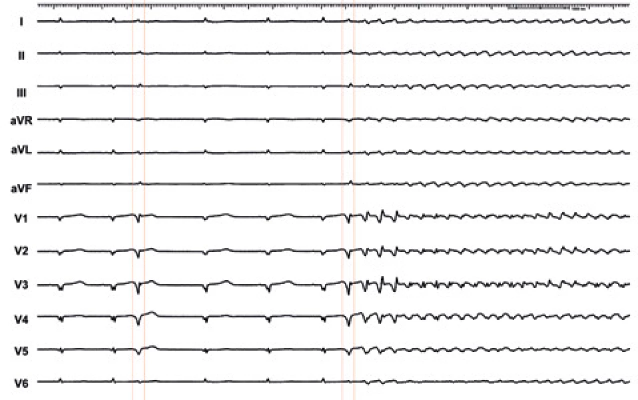 12svodové EKG v době arytmické bouře u pacienta po infarktu myokardu