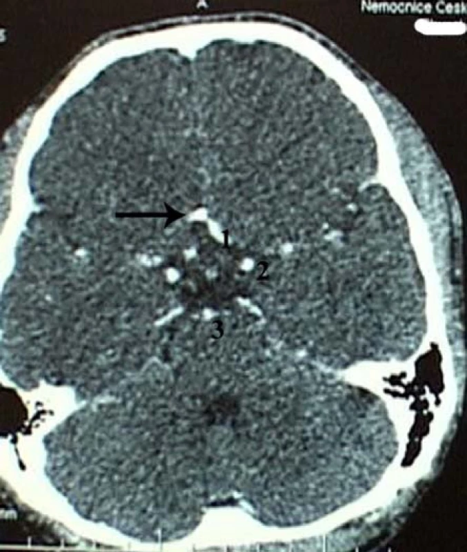 CT s kontrastem. Šipka ukazuje na přední komunikujíci tepnu. l- a. cerebri anterior (pars praecomunicalis), 2- a. cerebri interna, 3- a. basilaris