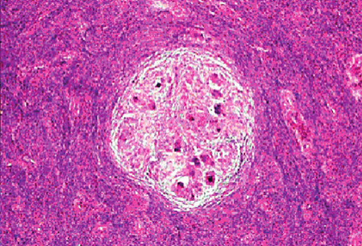 Sarkoidní granulom dělohy (archivní snímek MUDr. Žurkové)