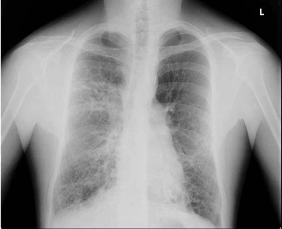 Zadopřední skiagram hrudníku pacienta s bronchiektáziemi na podkladě opakovaných aspirací při gastroezofageálním refluxu v dětství