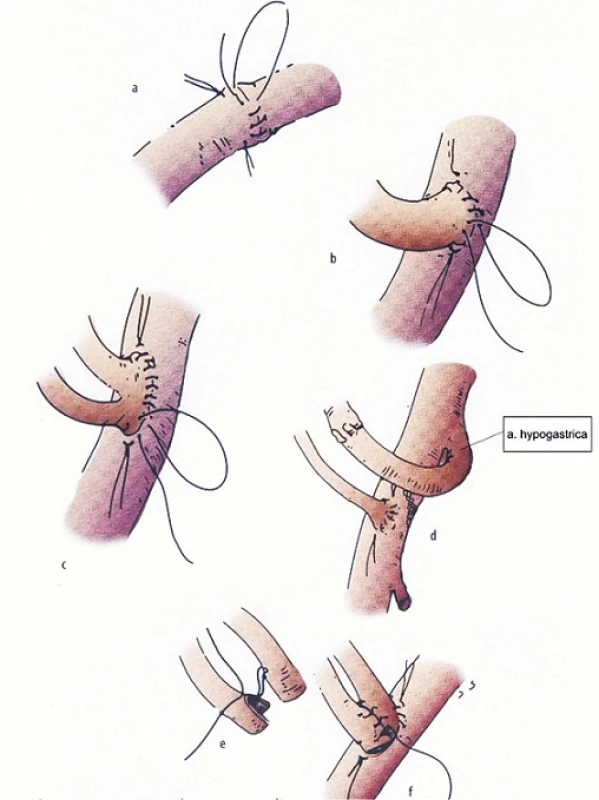 Možnosti rekonštrukcie renálnych artérií [12]
Fig. 6: Reconstruction options in renal arteries [12]