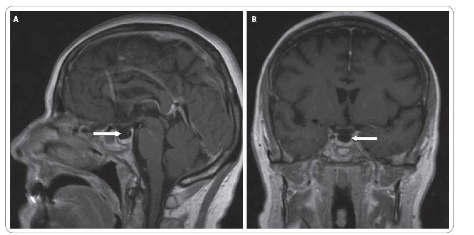 A. Sagitální řez MRI mozku. B. Koronární řez MRI mozku.