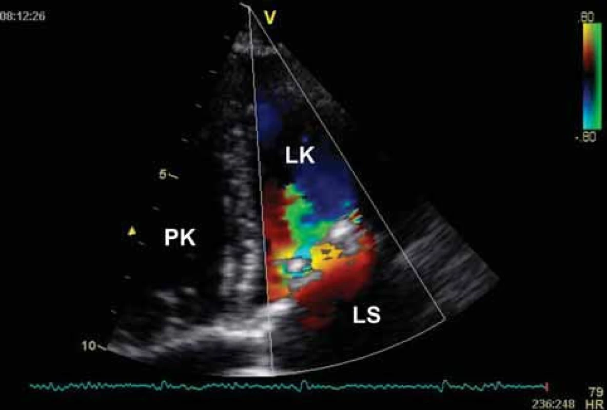 Echokardiografie u mitrální stenózy – CFM zobrazení. Turbulentní diastolický tok přes kalcifikované mitrální ústí.