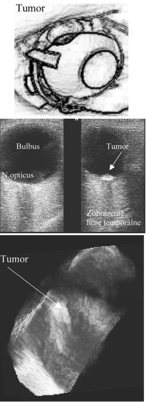 a. Tumor bulbu lokalizovaný v oblasti ekvátoru – schematicke zobrazenie tmavého ložiska v hornej polovine ekvátoru
b. 2D USG zobrazenie intrabulbárneho tumoru v oblasti ekvátoru. Na obrázku vľavo predozadný pohľad od bulbu ku hrotu orbity. Tumor je lokalizovaný v oblasti ekvátoru, preto je zobraziteľný len pri zmene polohy sondy a zmene polohy bulbu
c. 3D USG zobrazenie intrabulbárneho tumoru – časť bulbu v oblasti ekvátoru. Tumor je prekrytý retinou, pri rotácii zobrazenia je uložený v oblasti choroidey. Bez známok trakcie, sekundárnej amócie