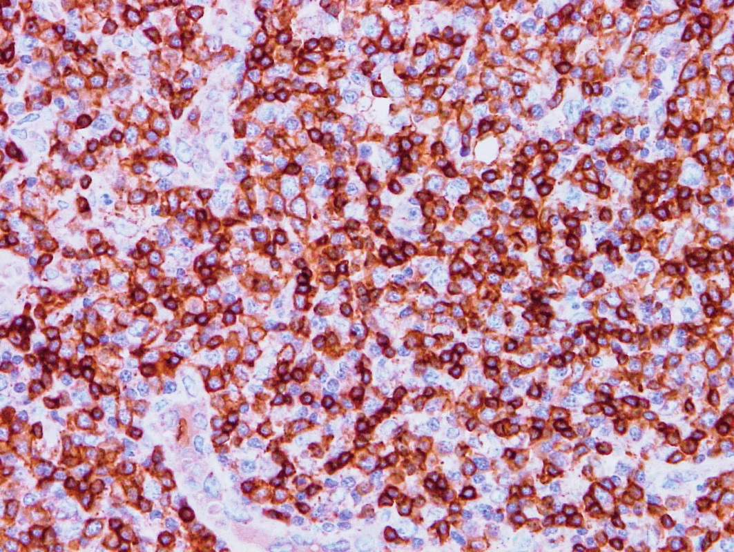 Vzorek z 1. bioptického odběru z roku 2013 – AITL 
CD5 pozitivita nádorových buněk, cévy jsou negativní.