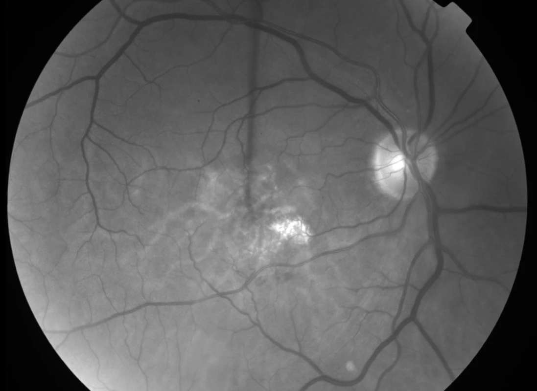 Bezčervený snímek fundu pravého oka pacienta 3 měsíce po FTV/RIV