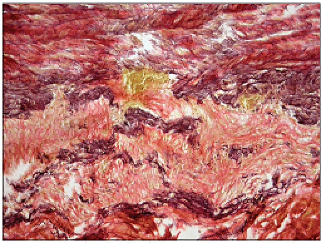 Destrukce elastických lamel v lamina media aortae. Barvení dle van Giesona s elastikou (původní zvětšení 200krát).