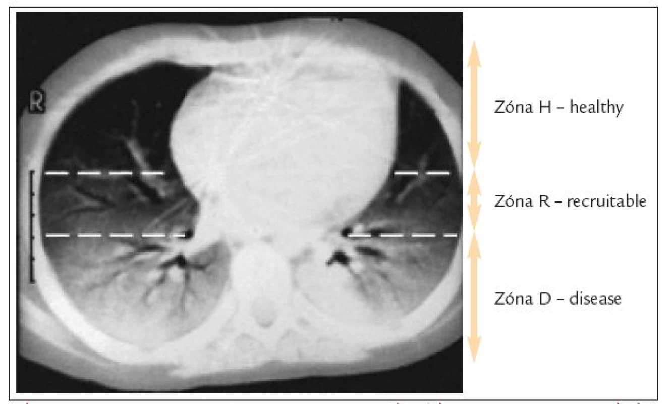 CT pľúc u pacienta s ARDS. Zóna H (healthy) je otvorená v priebehu celého dychového cyklu. Zóna R (recruitable) je otvorená na konci inspíria a na konci expíria kolabuje. Zóna D (disease) je zatvorená v priebehu celého dychového cyklu a nepodieľa sa na výmene krvných plynov.