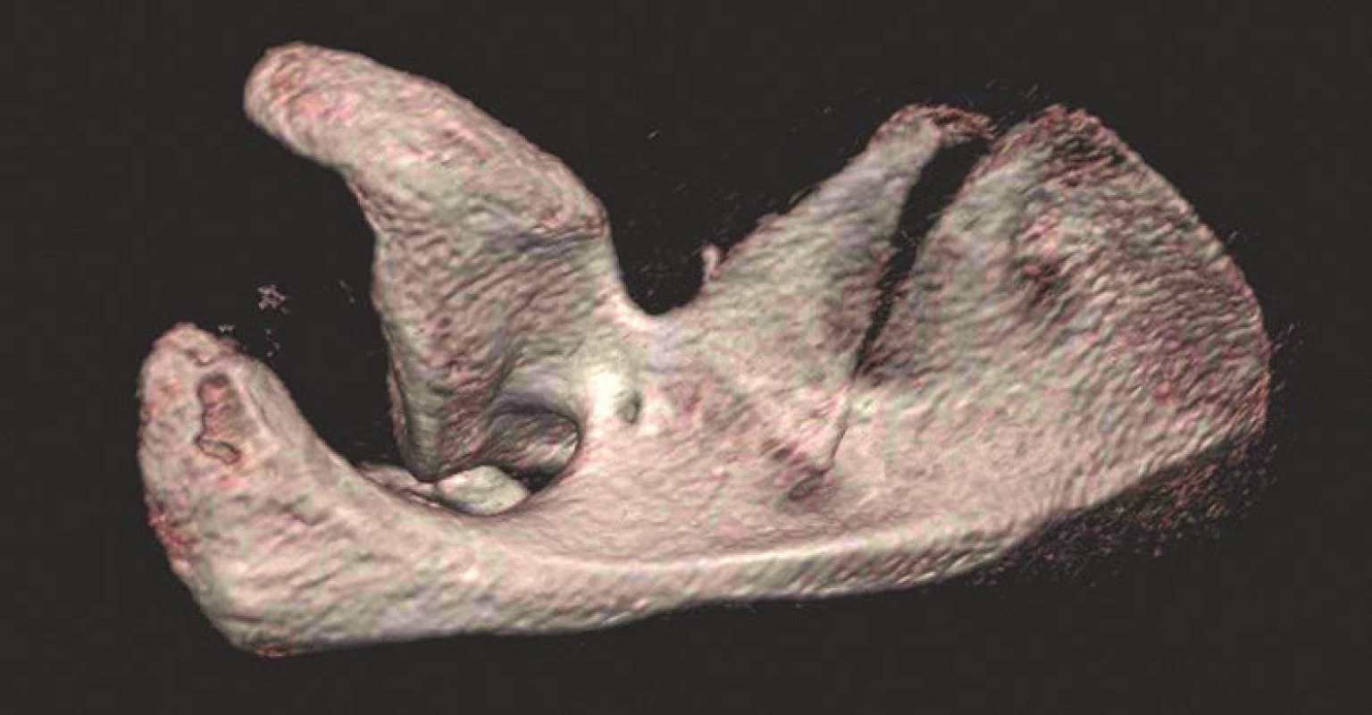 Význam 3D CT rekonstrukcí pro určení typu zlomeniny (v tomto případě transspinózní zlomeniny krčku lopatky: a – rtg snímek levého ramena zachycující zlomeninu, ale nelze určit její anatomii; b – 3D CT rekonstrukce – přední pohled; c – 3D CT rekonstrukce – zadní pohled; d – 3D CT rekonstrukce – pohled do supraspinátní jámy. 
Fig. 4: Importance of 3D CT reconstructions for determination of fracture type (in this case transspinous fracture of scapular neck: a – ap radiograph of left shoulder showing scapular fracture, but its anatomy cannot be identified; b – 3D CT reconstruction – anterior view; c – 3D CT reconstruction – posterior view; d – 3D CT reconstruction – view into supraspinous fossa.