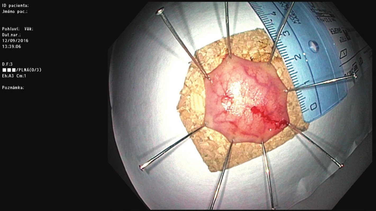 a) vtažení léze pomocí kleští do „capu“ FTRD; b) extrahovaný resekát našpendlený na korkovou podložku; c) naložený OTS klip po transmurální resekci („příznak terče“); d) resekát velikosti 30 mm po transmurální biopsii rekta u pacientky s podezřením na Hirschprungovu chorobu
Fig. 4: a) pulling the lesion into FTR cap; b) resected specimen pinned on cork; c) deployed OTS clip after full-thickness resection (the “target sign”); d) resected specimen measuring 30 mm from full-thickness rectal biopsy in a female patient with suspected Hirschsprung’s disease