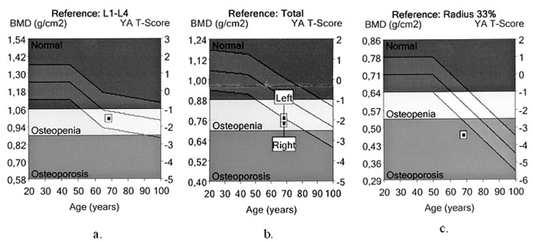 Denzita kostního minerálu (BMD) stanovená dvouenergiovou rentgenovou absorpciometrií (kostní denzitometrie)
a. BMD a T-skóre v oblasti bederní páteře (L1-L4)
b. BMD a T-skóre v oblasti proximálního femuru (Total)
c. BMD a T-skóre v oblasti distální třetiny předloktí (Radius 33%)