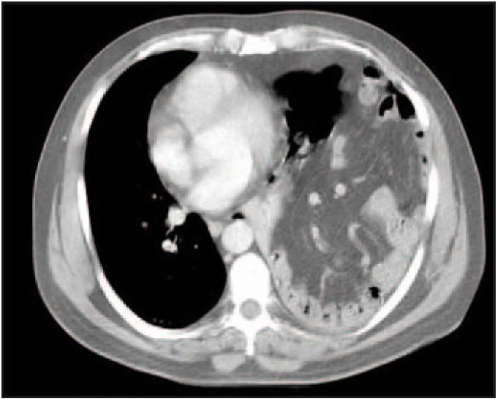 CT hrudníku s nálezem dislokace nitrobřišních orgánů do levého hemitoraxu (mesenterium, kličky tenkého střeva a žaludek) u ruptury levé poloviny bránice