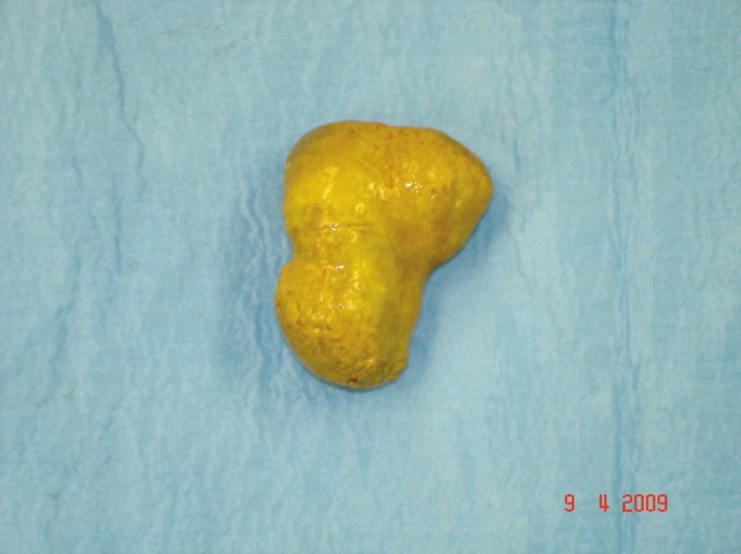 Odstraněný enterolit
Fig. 1. Removed enterolith
