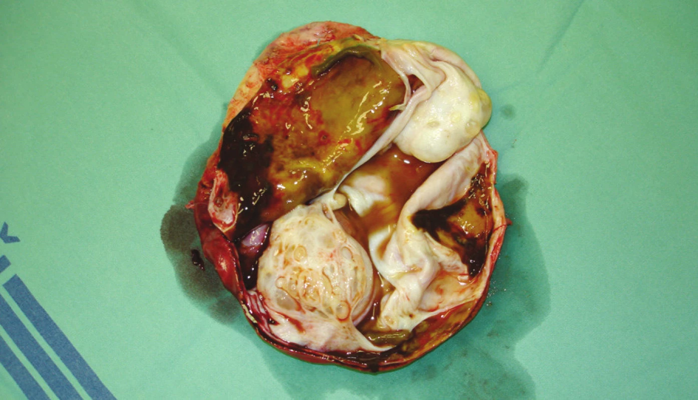 Cystadenom jater – preparát – případ 3 
Photo 3. Liver cystadenoma – a preparation – case No. 3