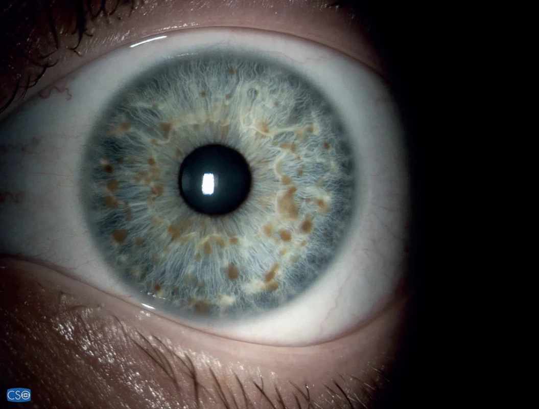 Lisch nodules of the iris can be distinguished from nevi by their three-dimensional appearance
