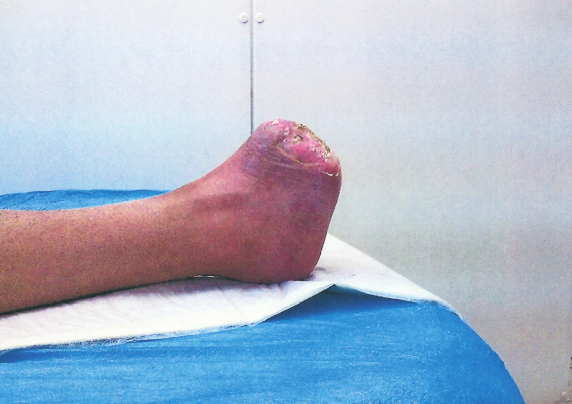 Zhojený defekt, funkce nohy plně zachována, transplantát mimo našlápnou zónu
Fig. 4. The healed defect, foot functions fully preserved, the transplant is aside from the stepping zone