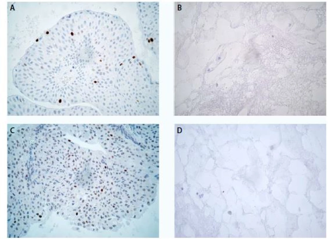 Low-grade uroteliální karcinom, imunochemické vyšetření markeru Ki-67 ve tkáni (A) a v cytobloku (B)
a markeru p53 ve tkáni (C) a v cytobloku (D), zvětšení 400×<br>
Fig. 1. Low-grade urothelial carcinoma, expression of Ki-67 in tissue section (A) and in cell block section (B) and
expression of p53 in tissue section (C) and in cell block section (D), magnification 400×