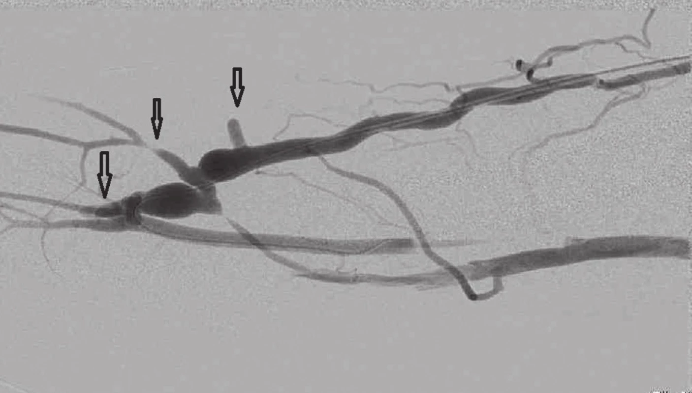 Fistulografie po podvazu 3 kolaterálních žil, šipky
Fig. 10: Fistulogram after ligation of 3 collateral veins; arrows