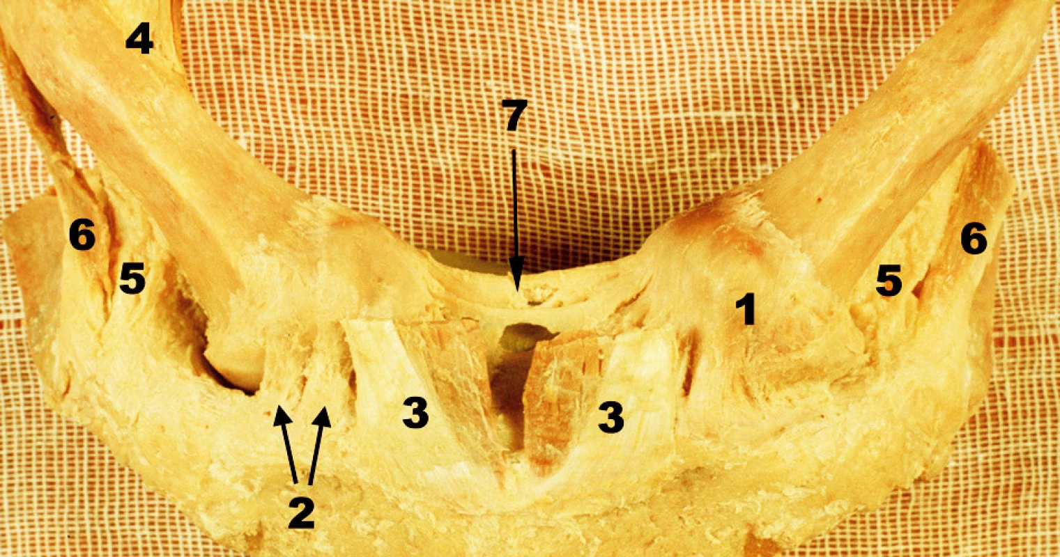 Oba sternoklavikulární klouby s přilehlou částí manubrium sterni – přední pohled, vpravo kloubní pouzdro částečně odstraněno. 1 – přední plocha pouzdra SC kloubu, 2. lig. sternoclaviculare ant., 3 – sternální porce m. sternocleidomastoiudeus, 4 – klavikulární porce m. sternocleidomastoideus, 5 – lig. costoclaviculare, 6 – šlacha m. subclavius, 7 – lig. interclaviculare Fig. 1. Both sternoclavicular joints with the adjacent part of the manubrium sterni – anterior view, the joint capsule was partially removed on the right side. 1 – anterior surface of the capsule of SC joint, 2 – anterior sternoclaviculare ligament, 3 – the sternal portion of sternocleidomastoid muscle, 4 – the clavicular portion of sternocleidomastoid muscle, 5 – costoclavicular ligament, 6 – tendon of subclavius muscle, 7 – interclavicular ligament