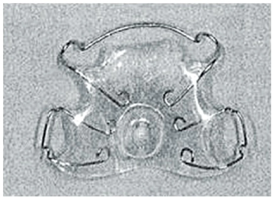 Patrová deska pro ozubenou horní čelist.
(Foto: Castillo Morales, 1998).