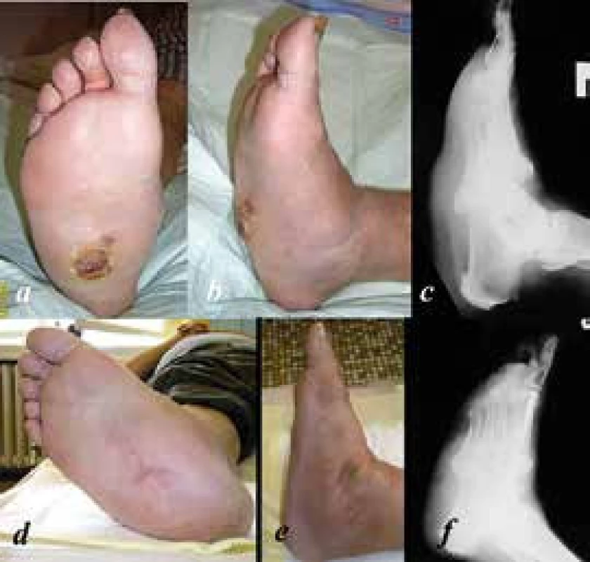 a, b: předoperační snímky nohy s Charcotovou neuroartropatií III. typu dle Sandersovy klasifikace s ulcerací plosky dlouhodobě nereagující na konzervativní léčbu, ve spádu zvažována velká amputace;
c: bočný RTG nohy s prolomením mediálního pilíře talonavikulárně;
d, e: 4 roky po rekonstrukci se zhojenou ulcerací;
f: rekonstrukce mediálního pilíře intramedulárním šroubem